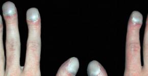 Борозды бо рейля — маникюрная дистрофия Нарушение питания ногтя